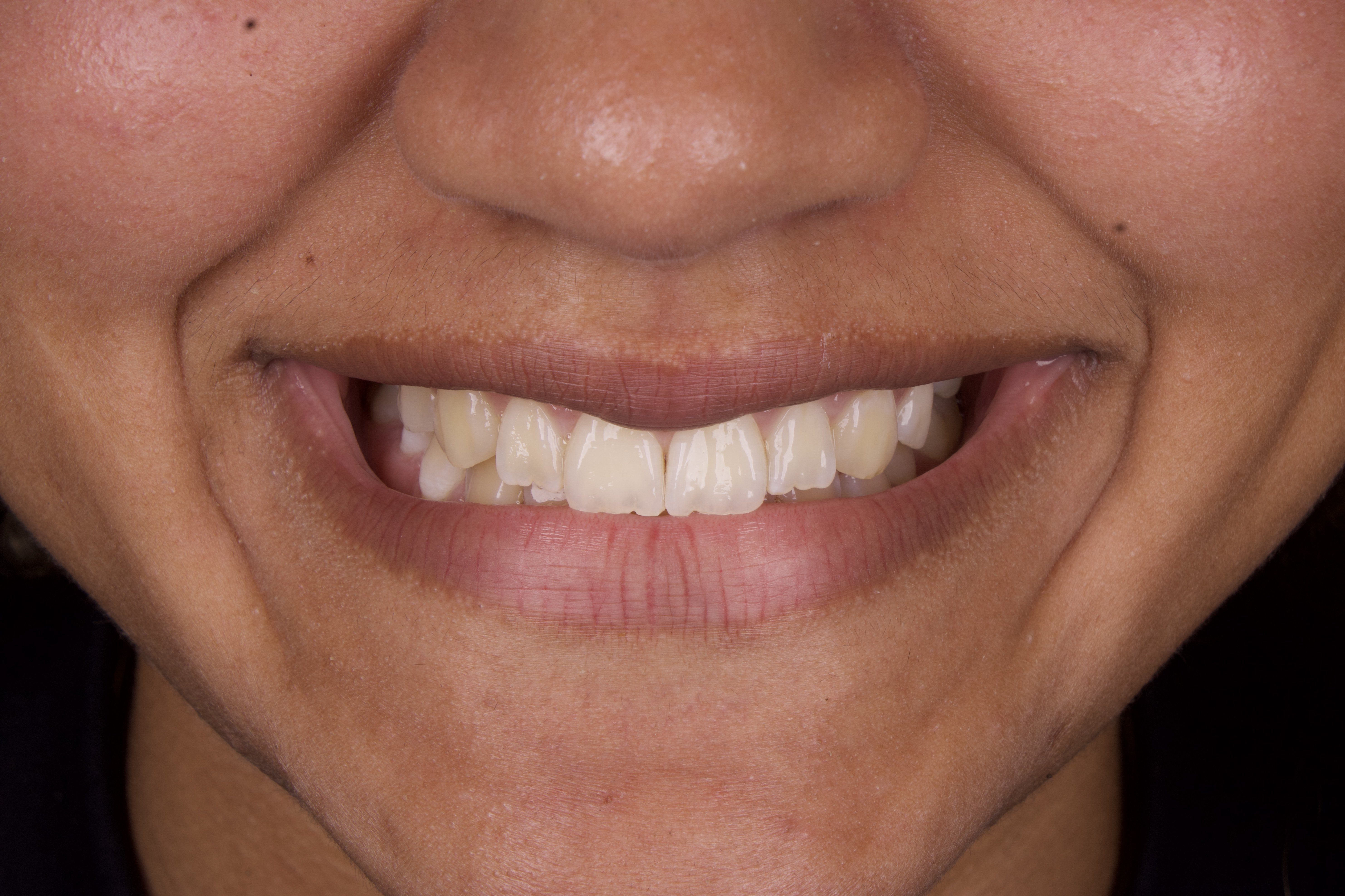 Antes do clareamento dental em consultório — Dra. Victória Vermelho, Copacabana