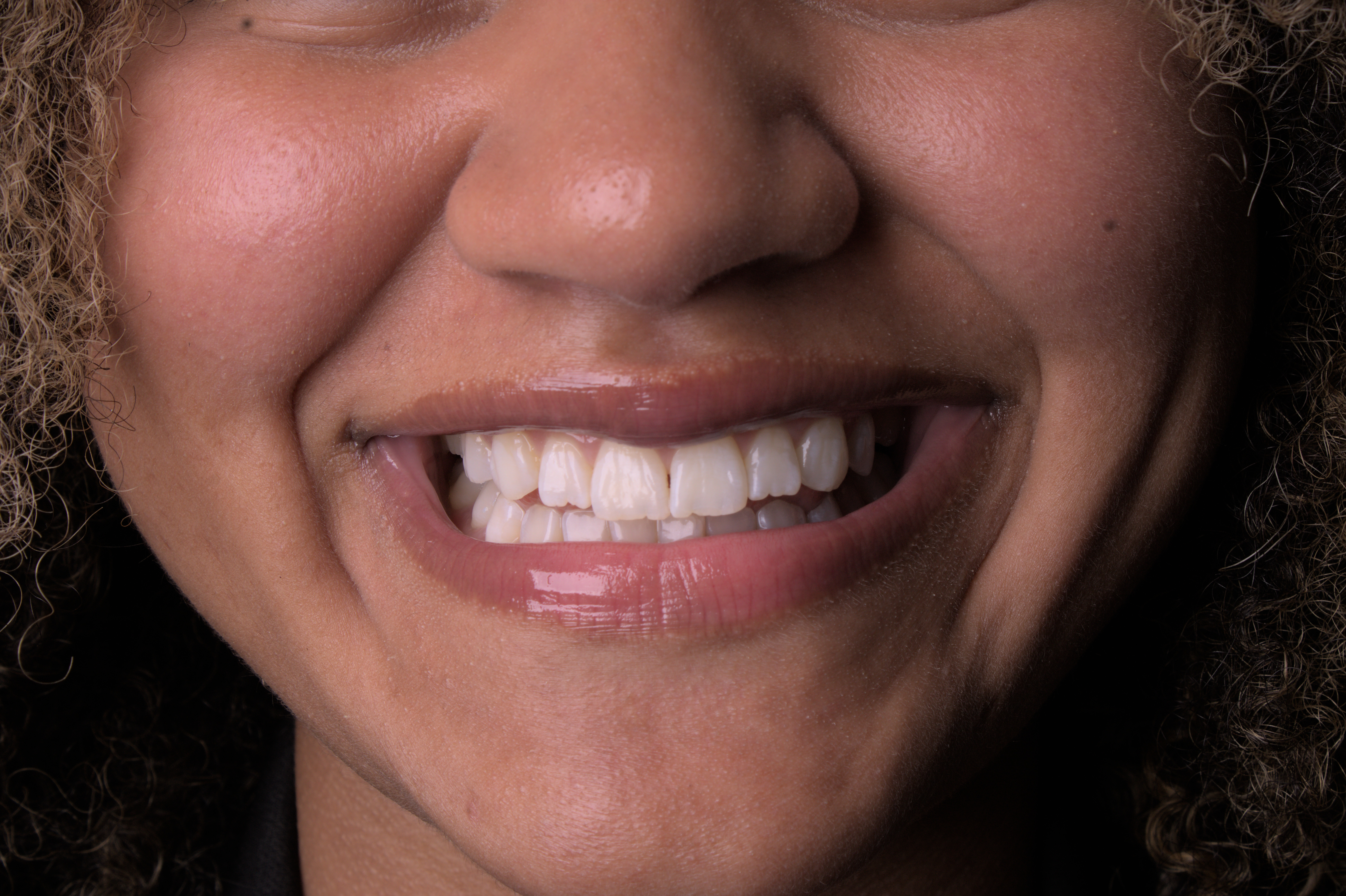 Resultado após 3 sessões de clareamento dental — Dra. Victória Vermelho