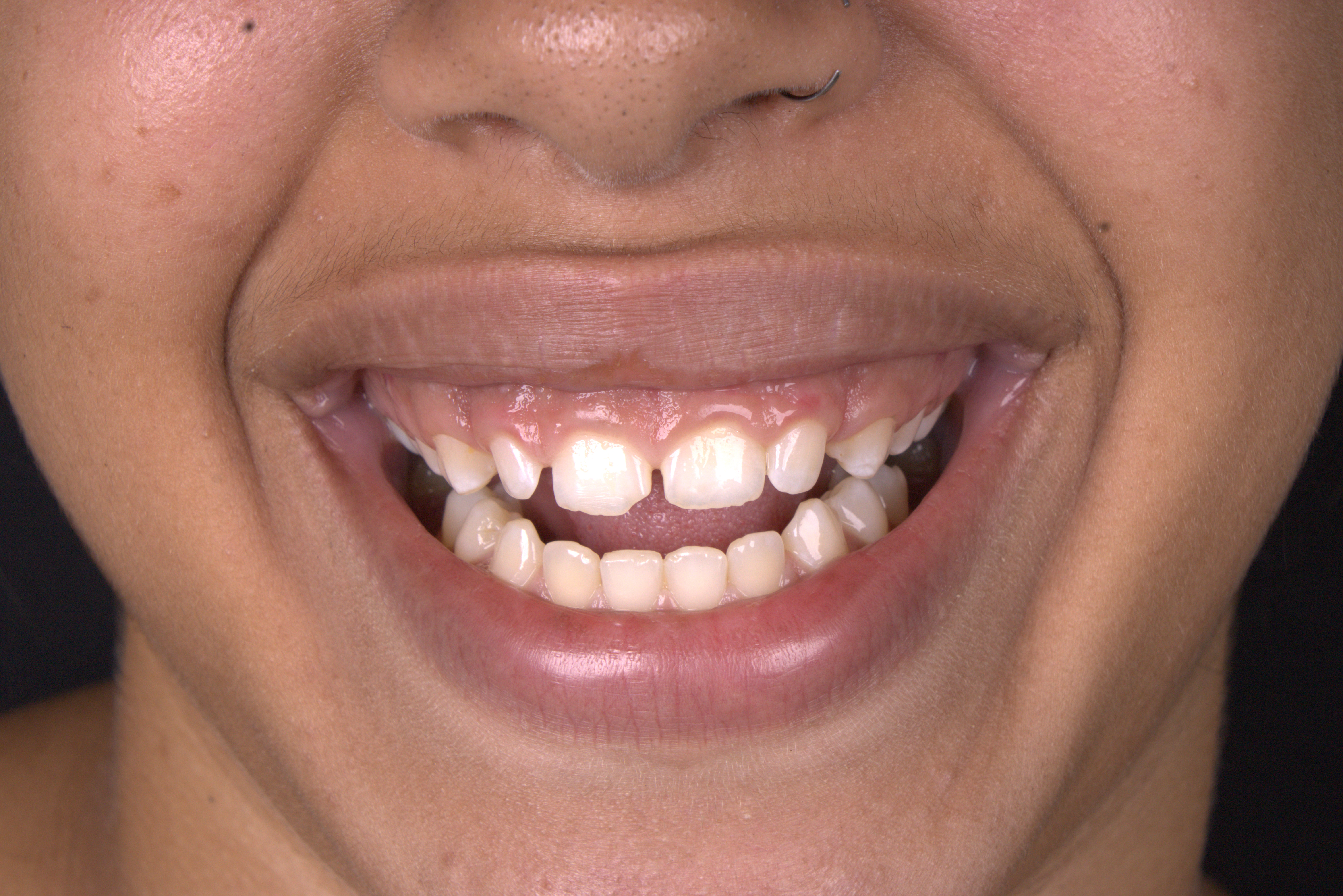 Antes da gengivoplastia e limpeza — Dra. Victória Vermelho, Copacabana