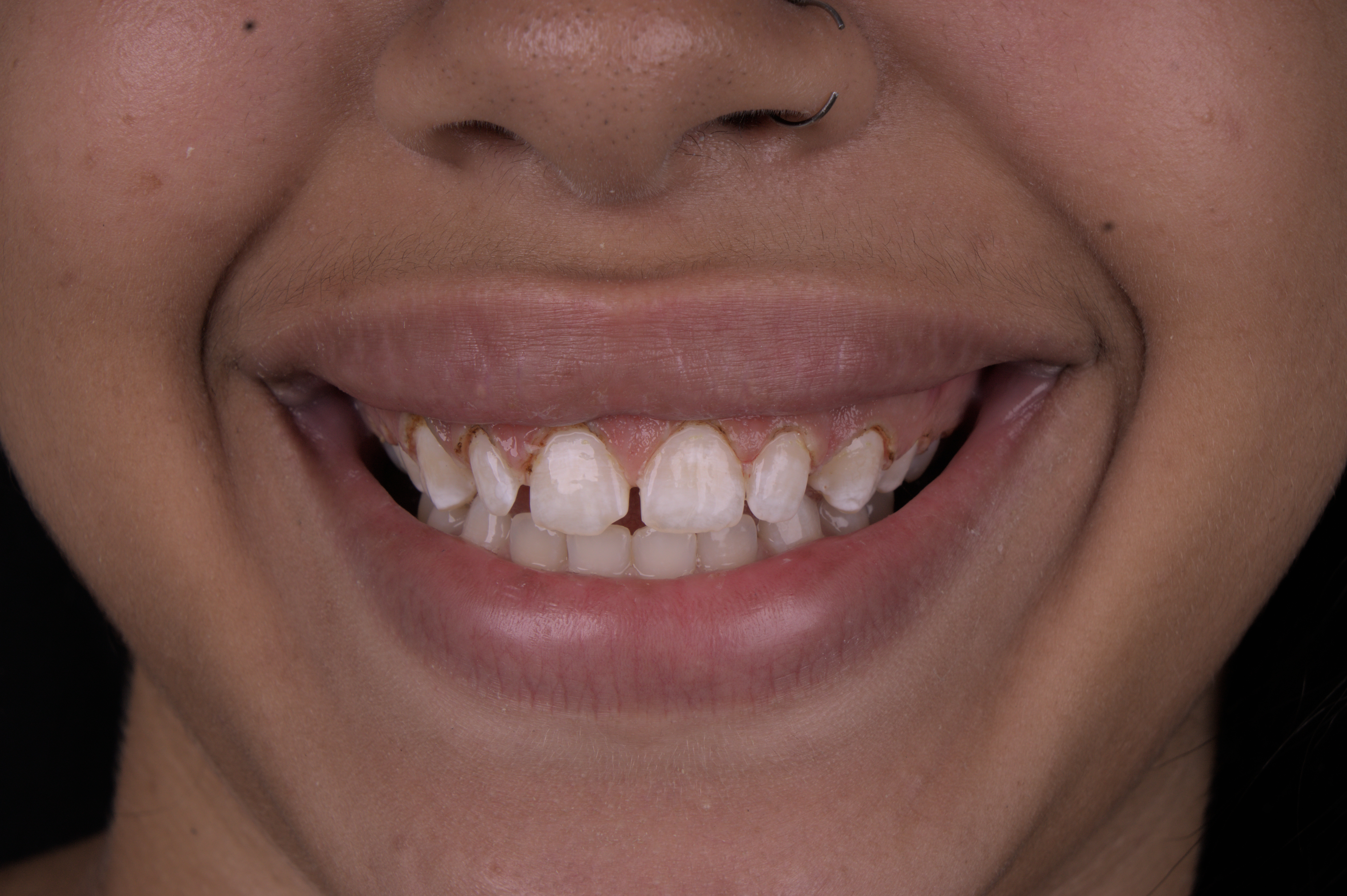 Resultado após gengivoplastia e limpeza — Dra. Victória Vermelho